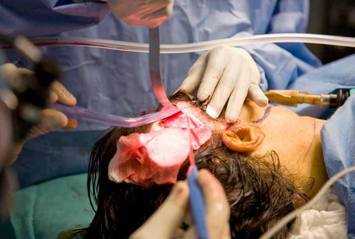 A face-lift operation is performed is no circulating nurse or anesthesiologist present.