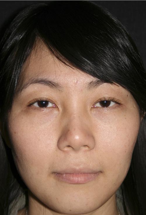51 Studies that have evaluated the Asian facial structure suggest that Asians have a weaker facial skeletal framework, which results in greater gravitational soft-tissue descent of the midface, malar