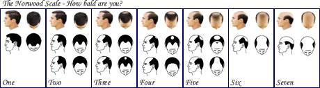Male pattern baldness is the cmmn type r cause f hair lss that develps in mst men at sme stage in their lives.