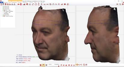 Face Mask for Scar Management - 3D Scanning imagery in your hands Using an IPad or Android device it is possible to get a fast non-intrusive 3D scan of your patients