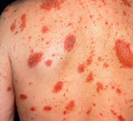 SPL a patchy red eczema rash seen on the back of a man s trunk emollients were used in conjunction with moderate and high-potency corticosteroids (Grimalt et al, 2007).