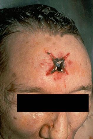Star shaped entrance wound,