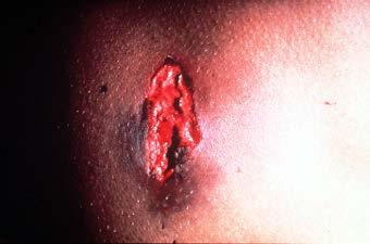 Graze Wound Bullet strikes at a shallow angle Produces an
