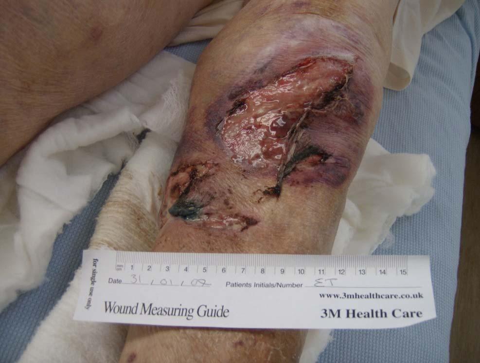 Wound cleansing Skin tears should be cleansed following assessment. Bacteria, debris, and/or necrotic tissue must be removed.