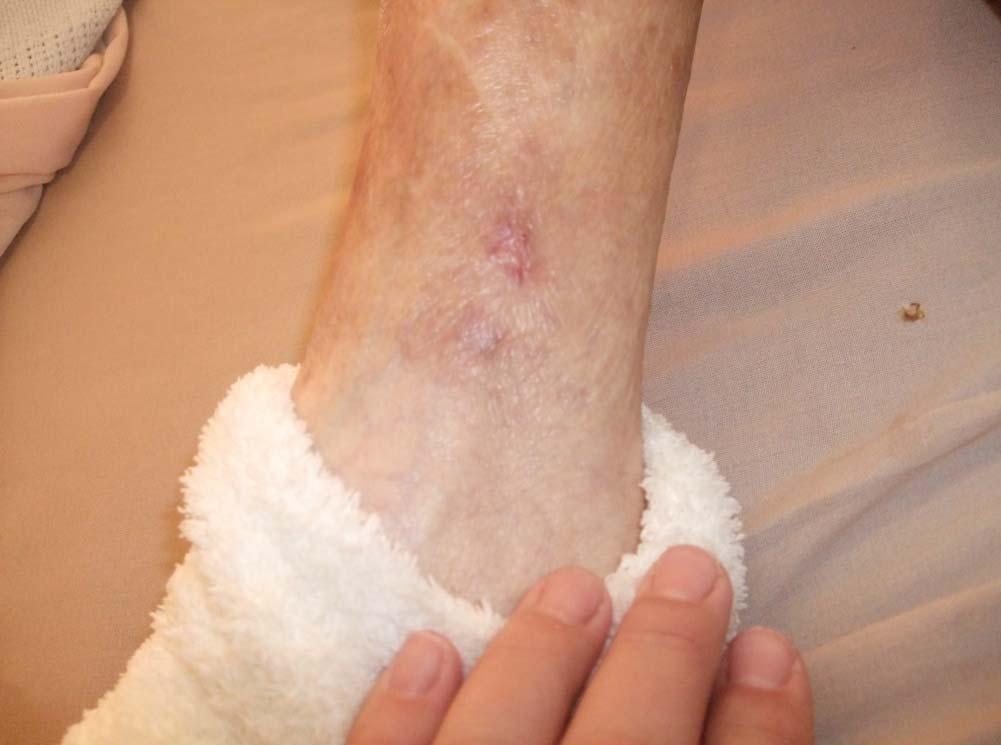Results ALLEVYN Gentle Border caused no trauma to the wound or the surrounding skin and the