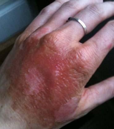 mundicare Burnaid for minor burns Smaller than the size of an adult s palm or 20c piece in a child Only involve the epidermis Red, warm and painful