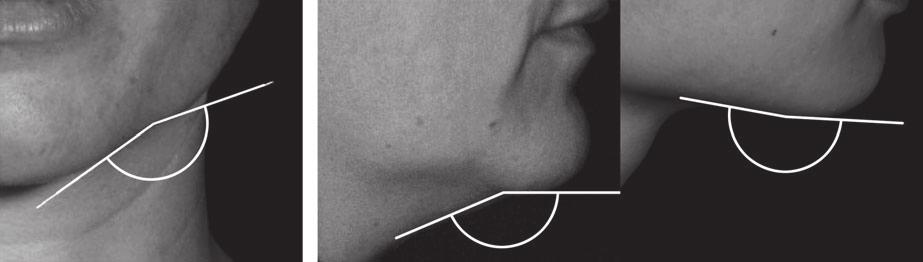 Machard et al. (a) (b) Fig. 4. Measurement points of the cheek/chin and neck/chin angles. (a) Determination of the cheek/chin angle.