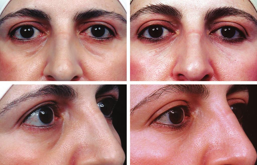 A 60-year-old woman before (left) and 6 months after (right) injection of tear troughs
