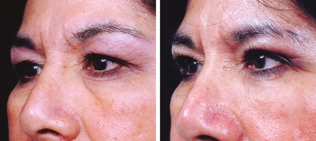 Volume 120, Number 6S Tear Trough Deformity Fig. 4. A 59-year-old patient before (left) and 4 months after (right) injection of 0.3 cc of hyaluronic acid per side.