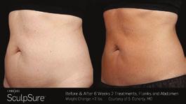 treatment) BEFORE AFTER UNRETOUCHED SCULPSURE PHOTOS COURTESY OF S. DOHERTY, MD Call for your free consulation today! 720.262.
