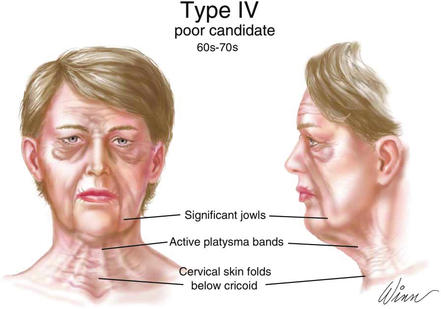 Figure 8. Presentation of a type IV patient, a poor candidate for minimal incision rhytidectomy. Table 5.