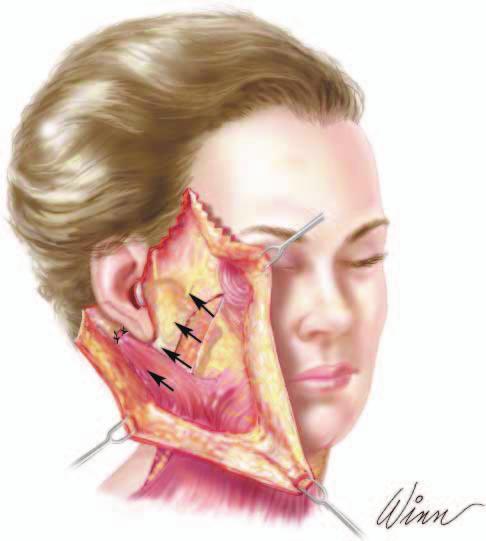 sive SMAS dissection is that facial nerve branches are placed in greater jeopardy.