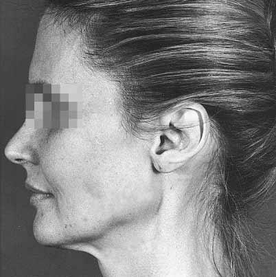 The patient had a septal cartilaginous graft placed at the nasal dorsum