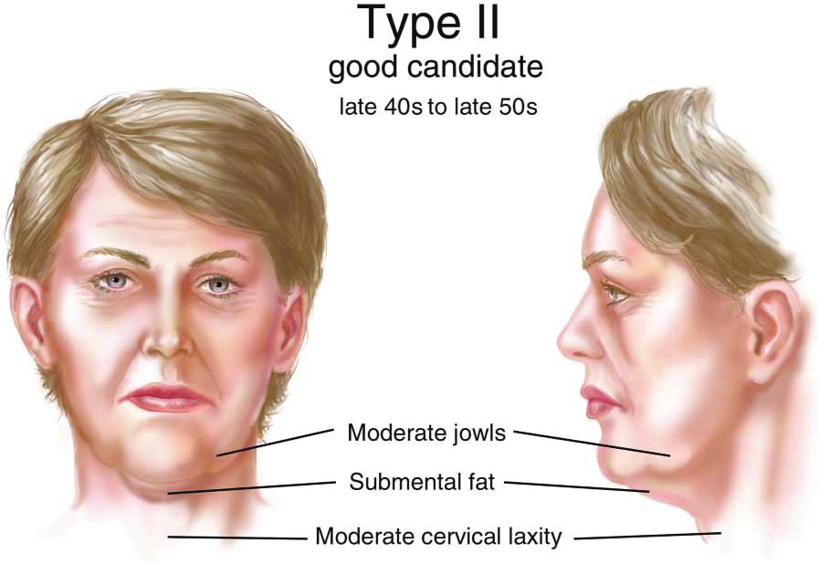 Figure 4. Presentation of a type II patient, a good candidate for minimal incision rhytidectomy. Table 3.