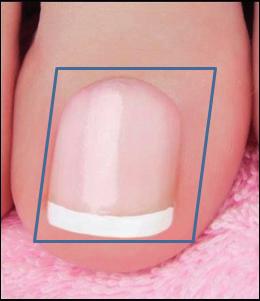 NAIL FUNGUS TREATMENT PARAMETERS The duration of the treatment depends on the size of the nails, the number of nails to be treated, the laser settings, the speed of the movement, and the tolerance of