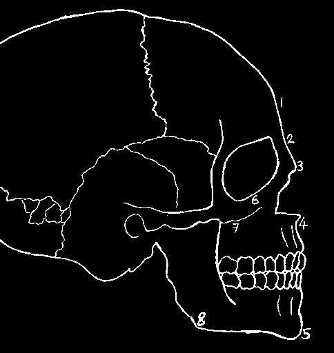 The pegs tell experts how deep the tissue and muscle is at various points on the skull.