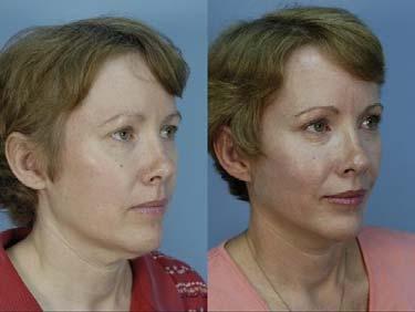 Newsletter. Options for Non-Surgical Age Management... "QT" Mini Facelift The "QT Mini Facelift" offers all the benefits of a full facelift with little down time and at about half the cost.