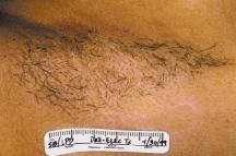 FIGURES 2A AND 2B 39 year old Skin Ethnic Color Type V patient, Axilla, 100 ms, 30