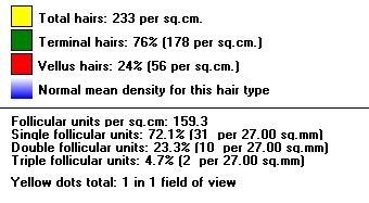 Hair diameter: Measured total: 62 hairs per 27.00 sq.mm Mean diameter: All hairs 61 +/- 2.2 µm Mean diameter: All Terminal hairs (>40 µm) 68 +/- 1.