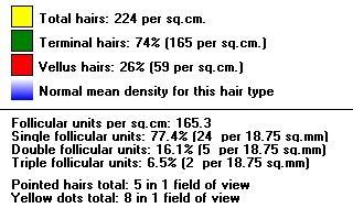 Hair diameter: Measured total: 42 hairs per 18.75 sq.mm Mean diameter: All hairs 40 +/- 2.0 µm Mean diameter: All Terminal hairs (>35 µm) 46 +/- 1.