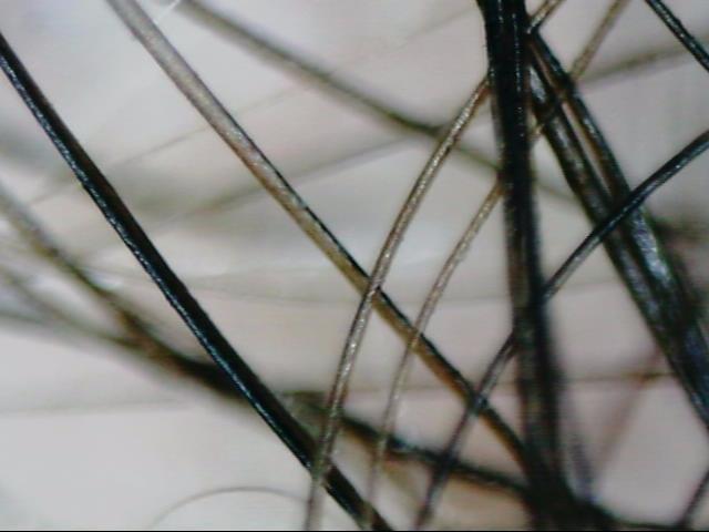 Parietal area (window: 1): - Hair diameter in parietal area (µm): Measured total: 8 hairs per 2.34 sq.mm Mean diameter: All hairs 45 +/- 6.