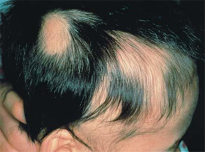 HAIR LOSS Androgenetic alopecia affects 40 million U.S. men. affects 20 million U.S. women.