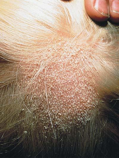 VEGETABLE PARASITIC Tinea capitis ringworm of the scalp Characterized by red