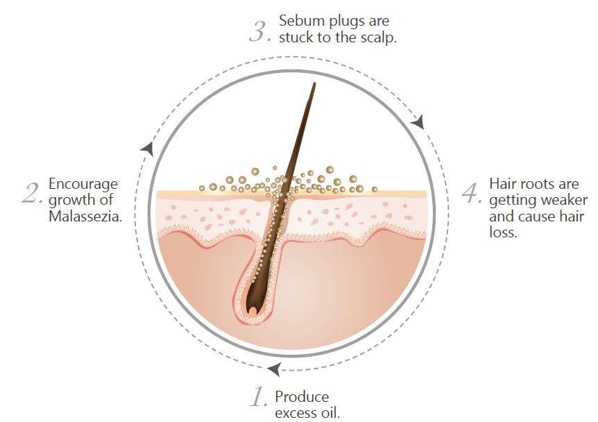 Most scalp problems are caused by excessive sebum secretion Aside from this, it