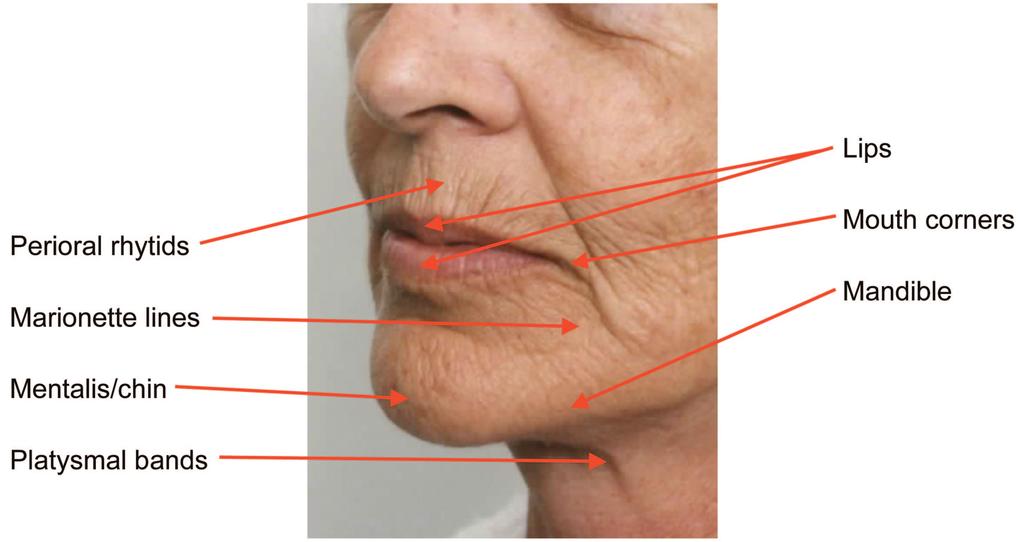 Plastic and Reconstructive Surgery May Supplement 2008 Fig. 3. Changes in the lower face due to aging.