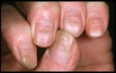 Some condition will require restriction and adaptation of the Gel Nail Polish treatment. These include mild eczema and psoriasis, minor nail separation and severely bitten nails.