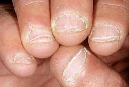 Bitten Nails : In most cases, only a small portion of the nail is visible, the edges of which are rough and uneven. The finger tips appears bulbous, there is not free edge.