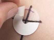 TAPE FALLS OFF Need to re-simulate or re-establish marks on patient who has lost them when the tape