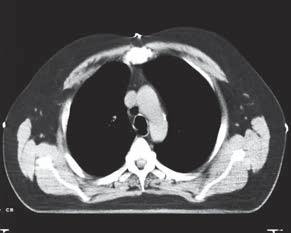 lung cases when used as a T to identify field borders CT-SPOT Crosshair marking breast field borders CT-SPOT Crosshair marking 3 point prostate