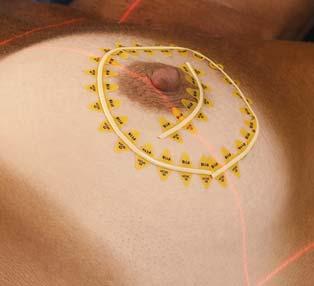 flexible line contour easily around corners CT-SPOT Line Breast Set-ups Strips used to mark superior, inferior,