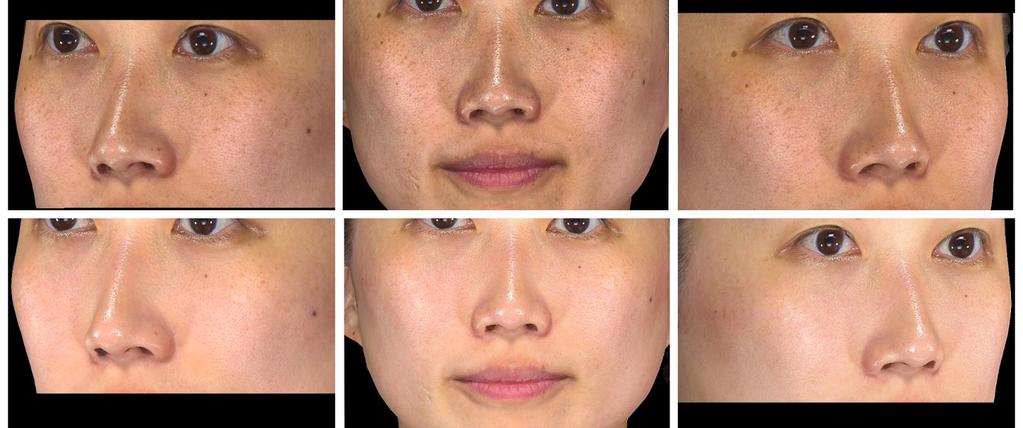 PicoSure Skin Revitalization Before After 3