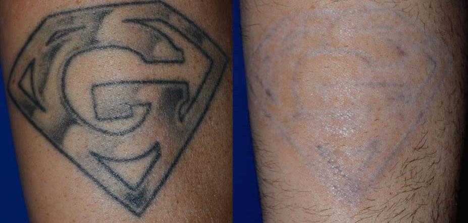 Tattoo removals in progress