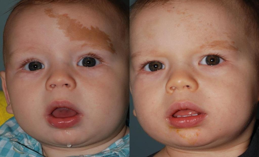 Pigment treatment (infant birthmark) Courtesy of Mark Taylor, MD 755