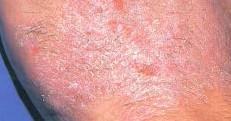 Symptoms usually begin with redness and irritation, and occasionally, swelling Blisters may follow and, if these break, the skin may become infected.