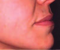 FILLERS FOR LINES, WRINKLES AND SCARS A variety of filling injections and implants have been