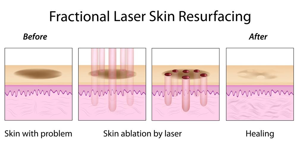 The Procedure There are two main types of laser skin resurfacing. CO2 Fractional laser skin resurfacing is the most effective and safest form of skin resurfacing.