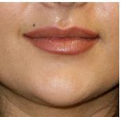 Remodeling & lip augmentation PRE Lip filler