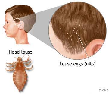 What do they look like and where are they found? Lice (the bugs) are grayish brown in color.