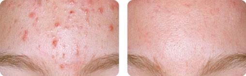 Facial peels Many problems that are related to excessive skin cells.
