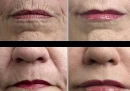 Wrinkle Reduction A loss of collagen and elastin in the dermis creates lines, wrinkles and sagging skin.