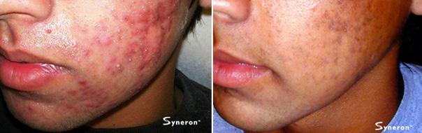 Acne Treatment Acne treatment uses light and radio frequency energies to target the sebaceous glands in the skin.
