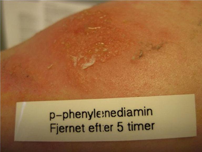 304 Pediatric Allergy (A Gimenez-Arnau, Section Editor) Prevention individual using a small aluminium chamber (8 mm) filled with PPD as free base or as a thin-layer rapid-use epicutaneous patch test.