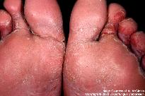 Athletes foot Image Fungal nail infections (onychomycosis) Fungal nail infections are often caused by the spread of athlete s foot, but can occur on their own.