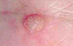 Tips Veruccas and warts can be treated with a dimethyl-ether propane spray that freezes the core of the infected area.