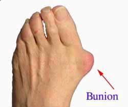 Bunion Plantar Fasciitis Image A bunion is an enlargement on the side of the foot near the base of the big toe (hallux). The enlargement is made up of a bursa (fluid filled sac) under the skin.