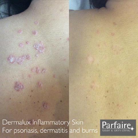 Results can last for several months following a course of Dermalux LED phototherapy treatments.